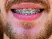 ارتودنسی درد داره ولی دندون پزشک به شما نمیگه ؟!