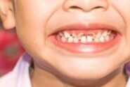 دندان کودک شما چه رنگی شده ؟ هر رنگ علتی دارد